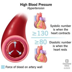 Cleveland Clinic High Blood Pressure Image in this remote blood pressure monitoring article. 